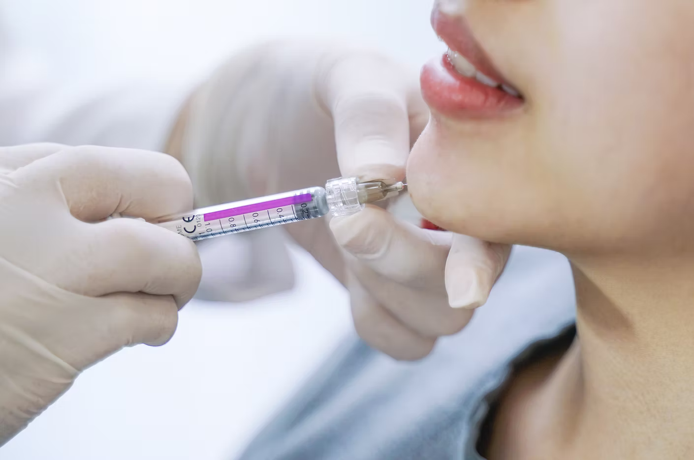 Lower Face Filler Treatment